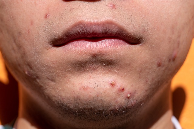 Acne Scar Reduction with Morpheus8
