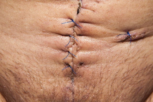 Acne Scar Reduction with Morpheus8