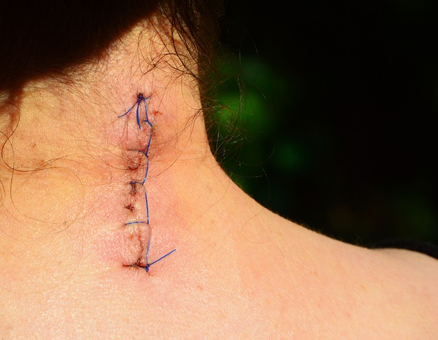Acne Scar Reduction with Morpheus8