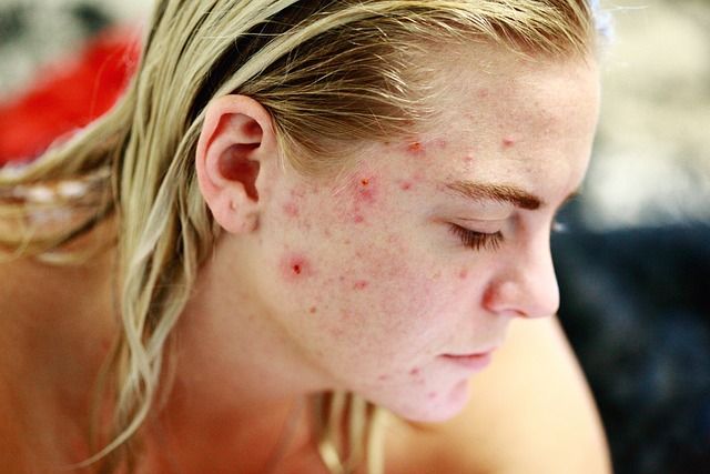 Acne Scar Reduction with Morpheus8