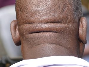 Morpheus8 Neck Tightening: Revolutionize Your Youthful Look