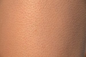 Unlocking Glowing Skin: A Comprehensive Guide to RF Skin Resurfacing