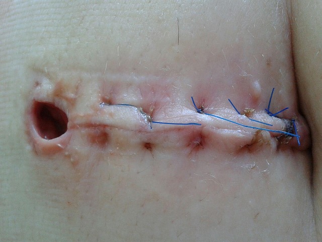 Abdominal CoolSculpting
