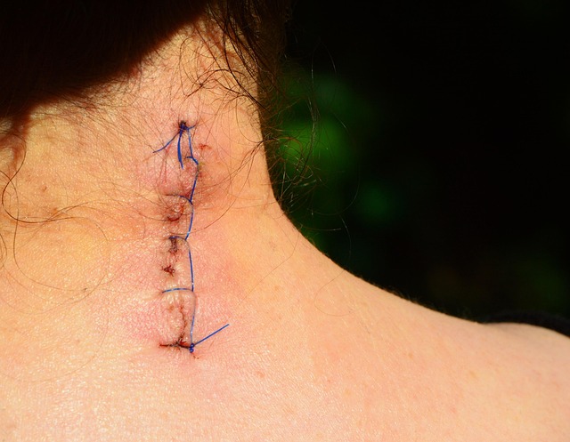 Acne Scar Reduction with Morpheus8