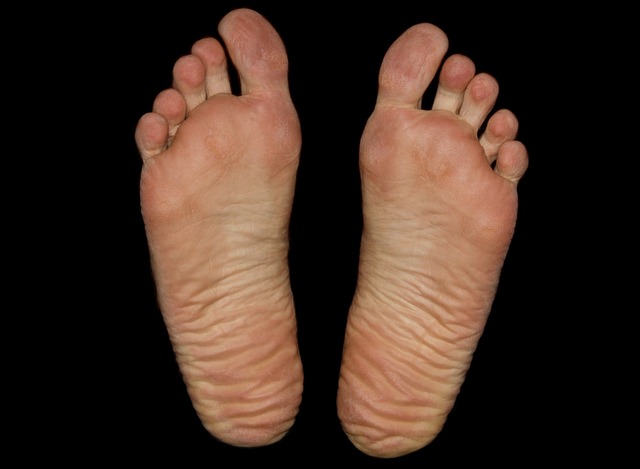 Botox for Crow’s Feet and Smile Lines
