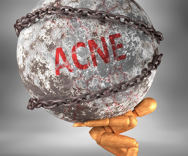 Acne Scar Reduction with Morpheus8