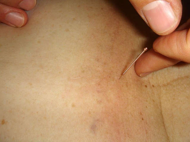 IVF acupuncture Austin