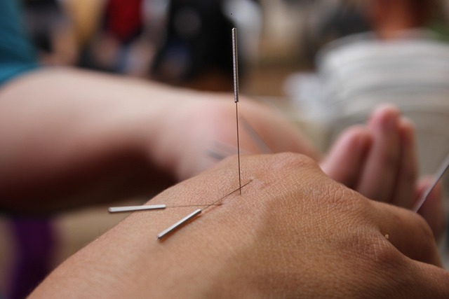 pain relief acupuncture