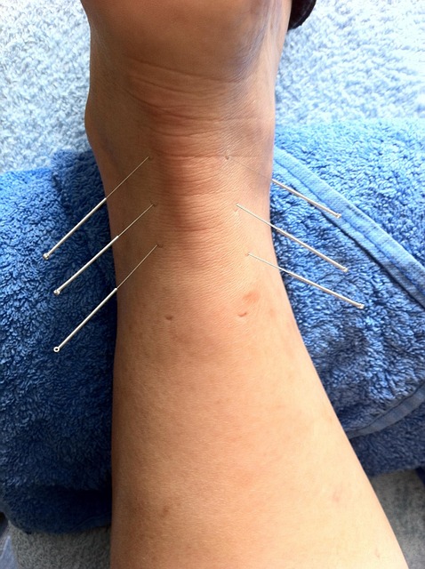 reproductive acupuncture