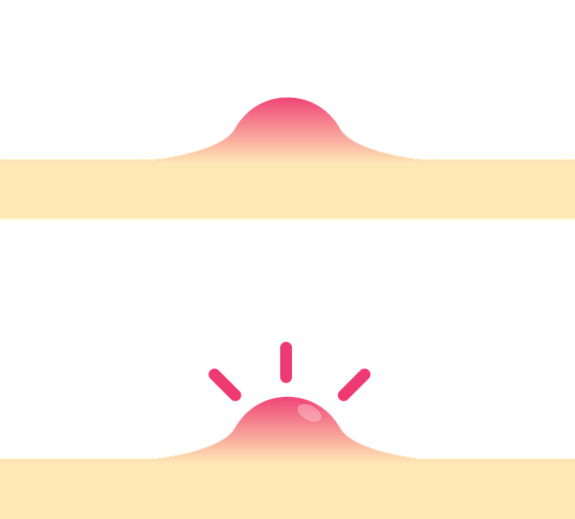 RF Skin Resurfacing